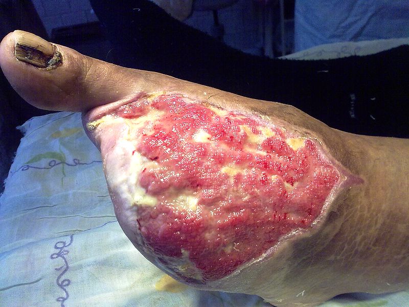Диабетическая ангиопатия, диабетическая ангиопатия нижних конечностей, диабетическая ангиопатия сосудов нижних конечностей Диабетическая ангиопатия, диабетическая ангиопатия нижних конечностей, диабетическая ангиопатия сосудов нижних конечностей